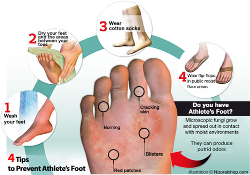 Illustration of how you get athlete's foot and tinea pedis and tips to prevent athlete's foot