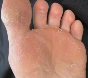 San Francisco Podiatrist picture of athlete's foot in a Bay Area triathlete.